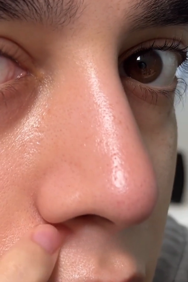 How to Reduce Open Pores Naturally (10 Proven Tips) 10 How to reduce open pores