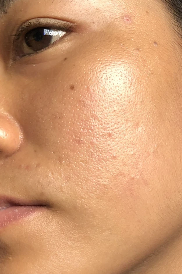 How to Reduce Open Pores Naturally (10 Proven Tips) 5 How to reduce open pores